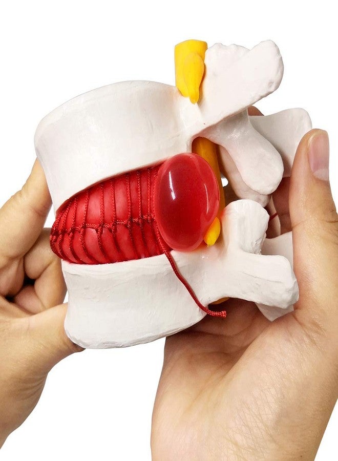 EVOTECH SCIENTIFIC Human Herniated Disc Model, Anatomical Herniated Lumbar Vertebrae Disc Prolapse Model for Medical Teaching Learning, Education Display Tooling, Student Learning Education Display Tool 3 Pack - Image 2